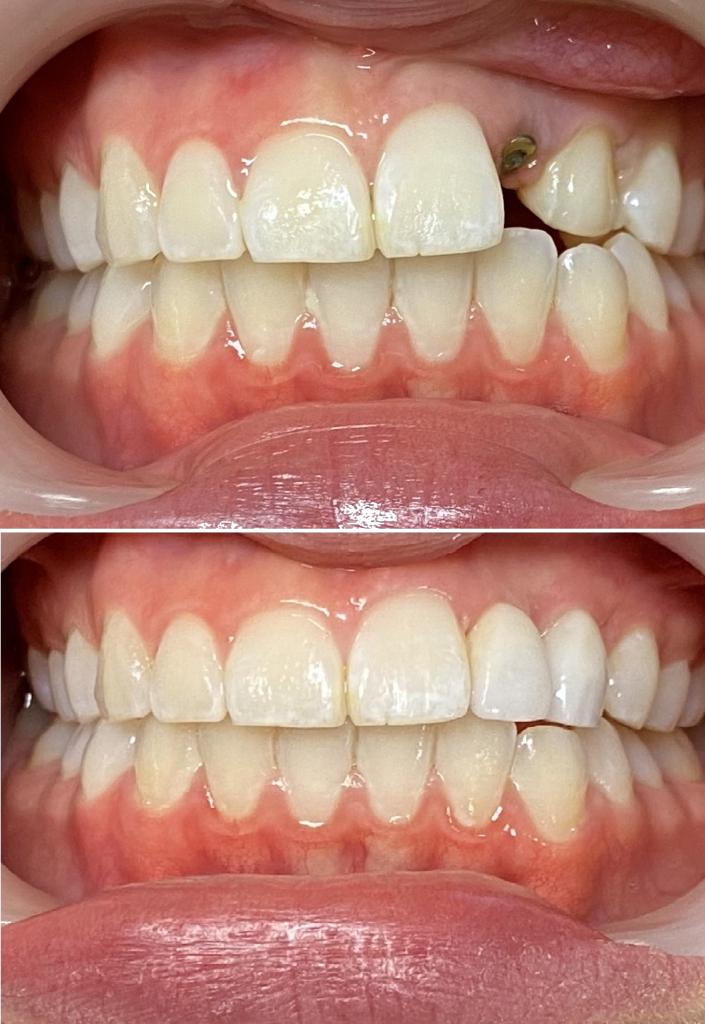 implant