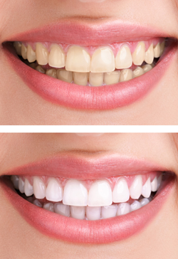 whitening