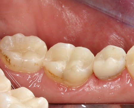 cerec after