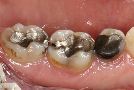 cerec before