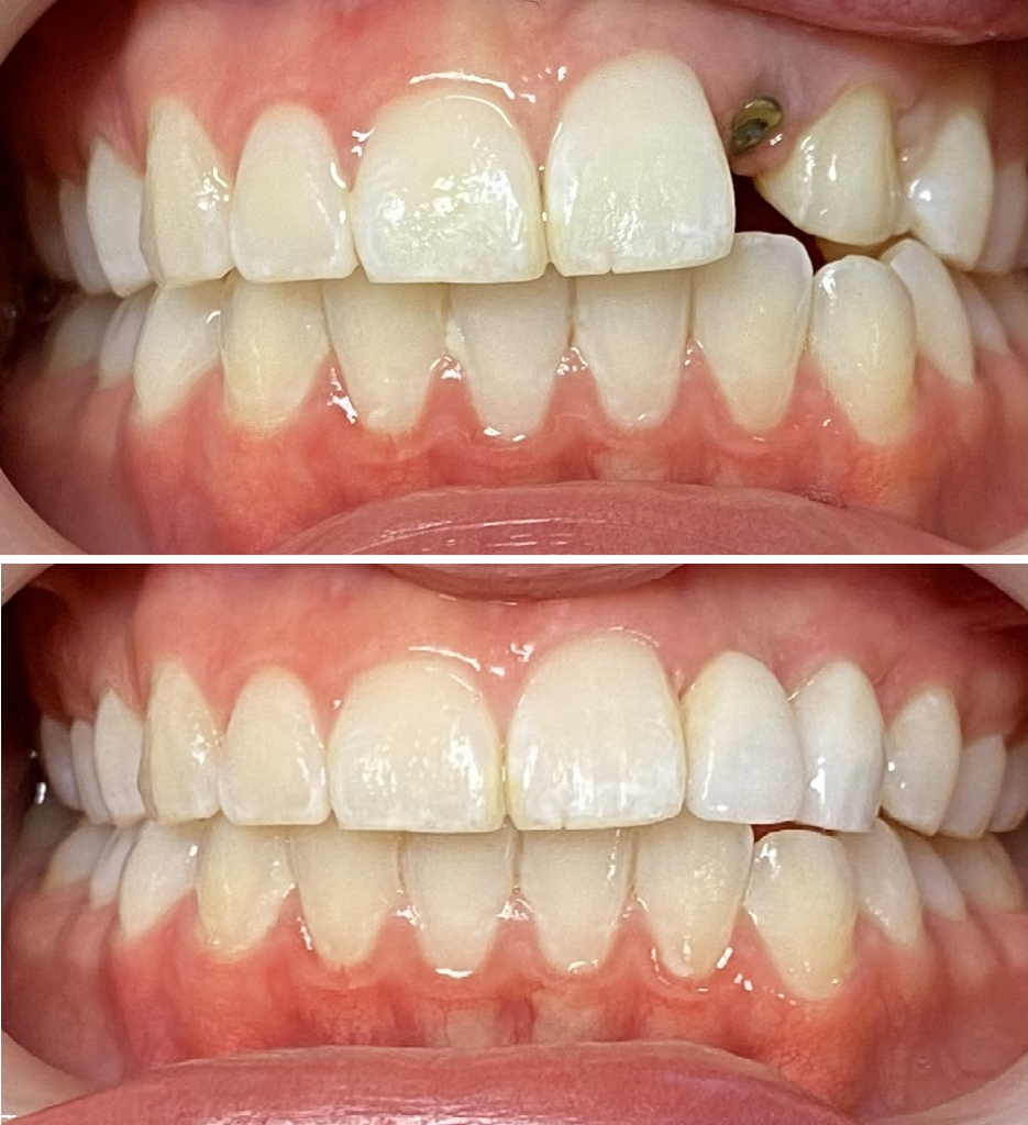 implant single