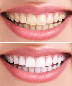 whitening