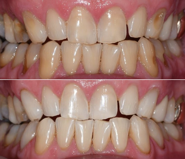 whitening