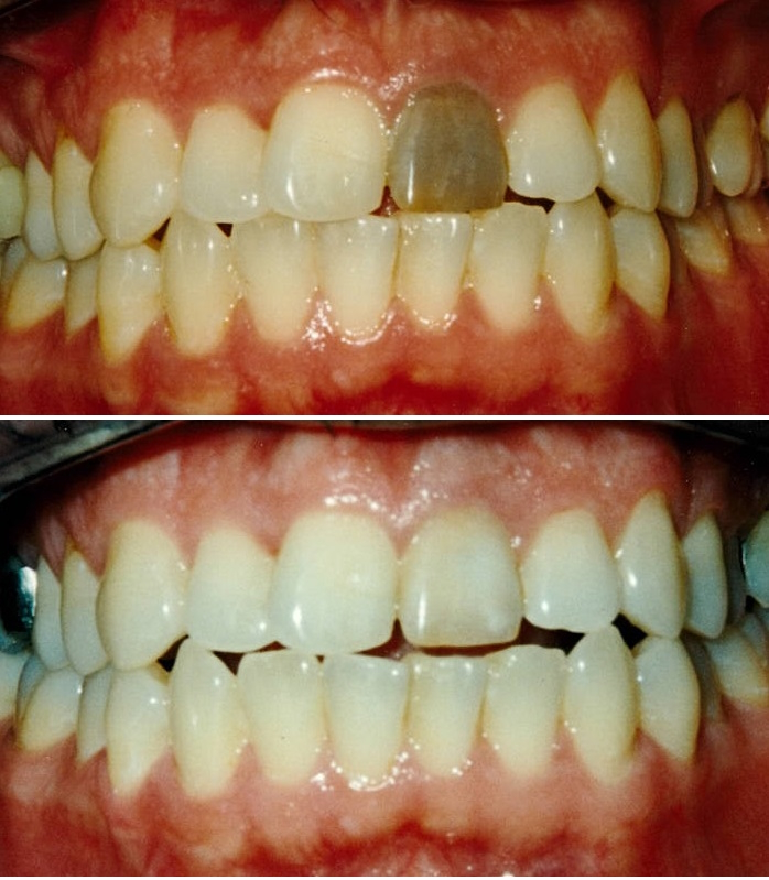 single tooth bleach